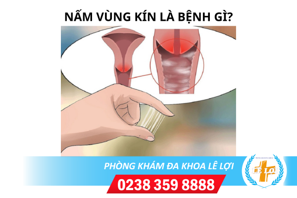 Nấm ngứa vùng kín là bị bệnh gì?