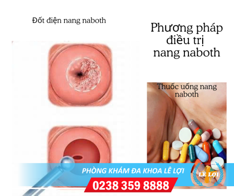 Điều trị nang naboth tử cung thế nào?