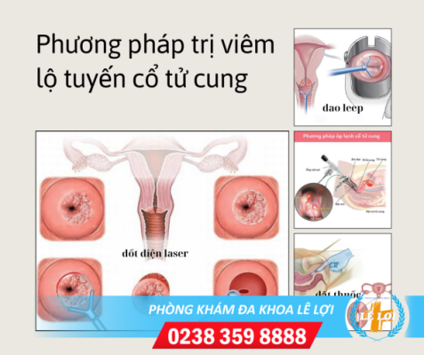 Chi phí đốt lộ tuyến cổ tử cung bao nhiêu tiền?