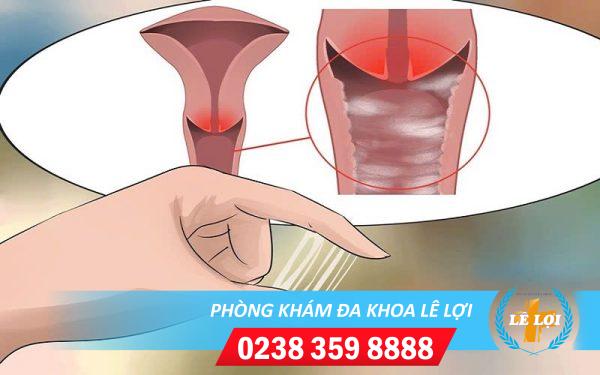 Nguyên nhân và cách khắc phục ra nhiều dịch âm đạo