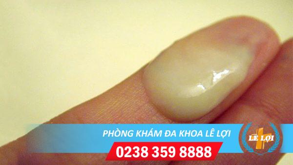 Ra dịch màu vàng là bị bệnh gì nguy hiểm không?