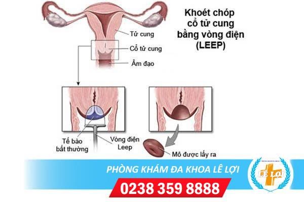 Cách điều trị polyp cổ tử cung