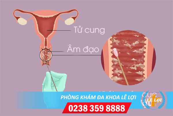 Âm đạo ra dịch bã đậu nguy hiểm không?