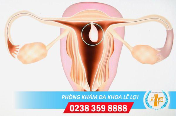 Nạo polyp tử cung là gì nguy hiểm không?