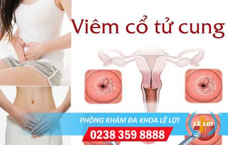 Chi phí điều trị viêm cổ tử cung bao nhiêu?