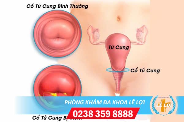 Điều Trị Viêm Tử Cung Ra Sao?