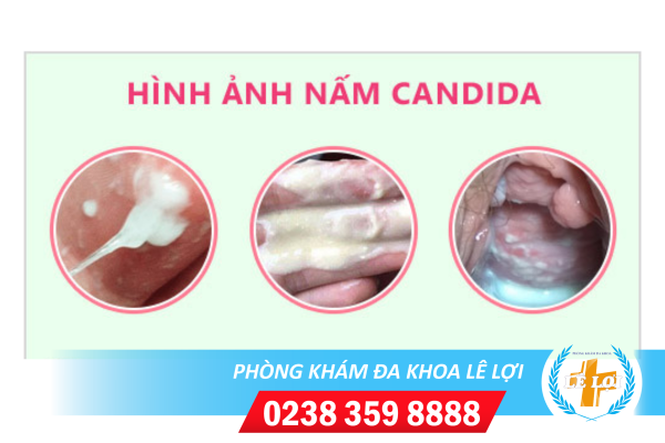 hinh-anh-nam-candida