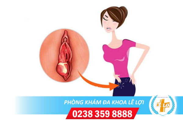 Môi lớn âm đạo bị sưng là dấu hiệu bệnh gì?