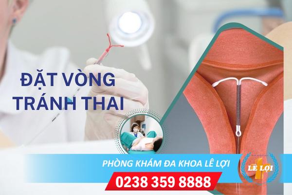 Chi phí đặt vòng tránh thai bao nhiêu tiền?