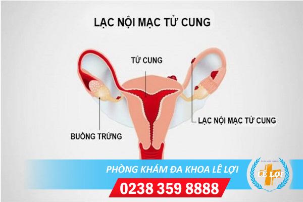 Triệu chứng lạc nội mạc tử cung và cách chữa trị