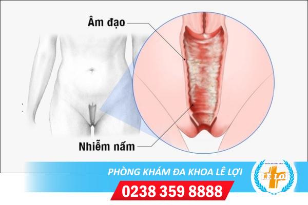 Thuốc điều trị nấm candida âm đạo hiệu quả