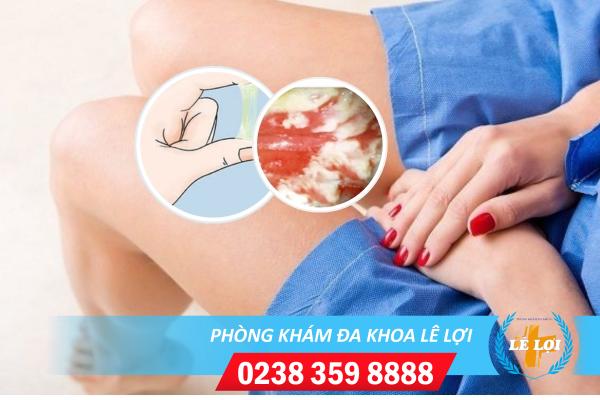 Dấu hiệu viêm âm đạo cấp và mãn tính